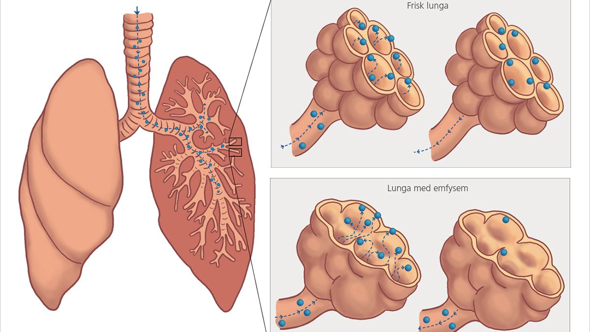 Grafik över lungor