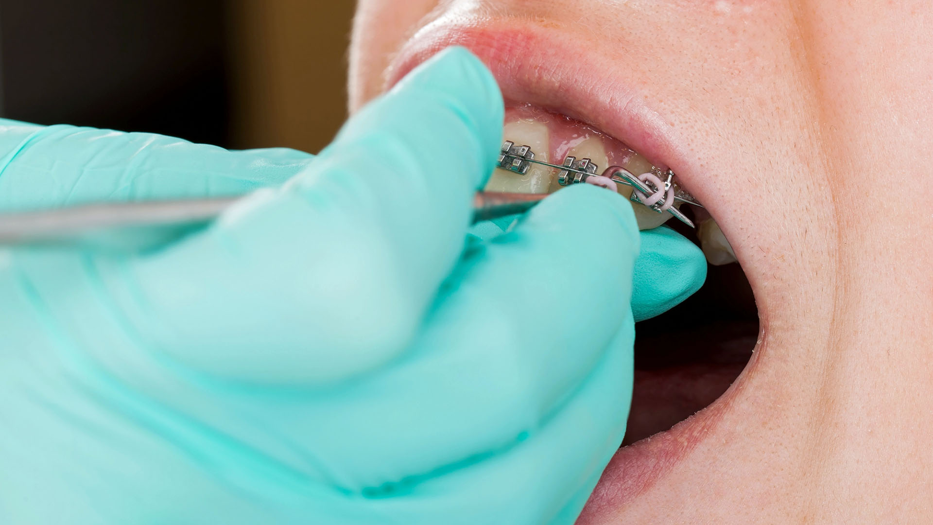 Children are stressed by anesthesia during dental care