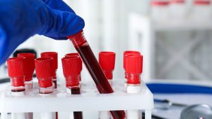 Behållare med blodprover på ett labb