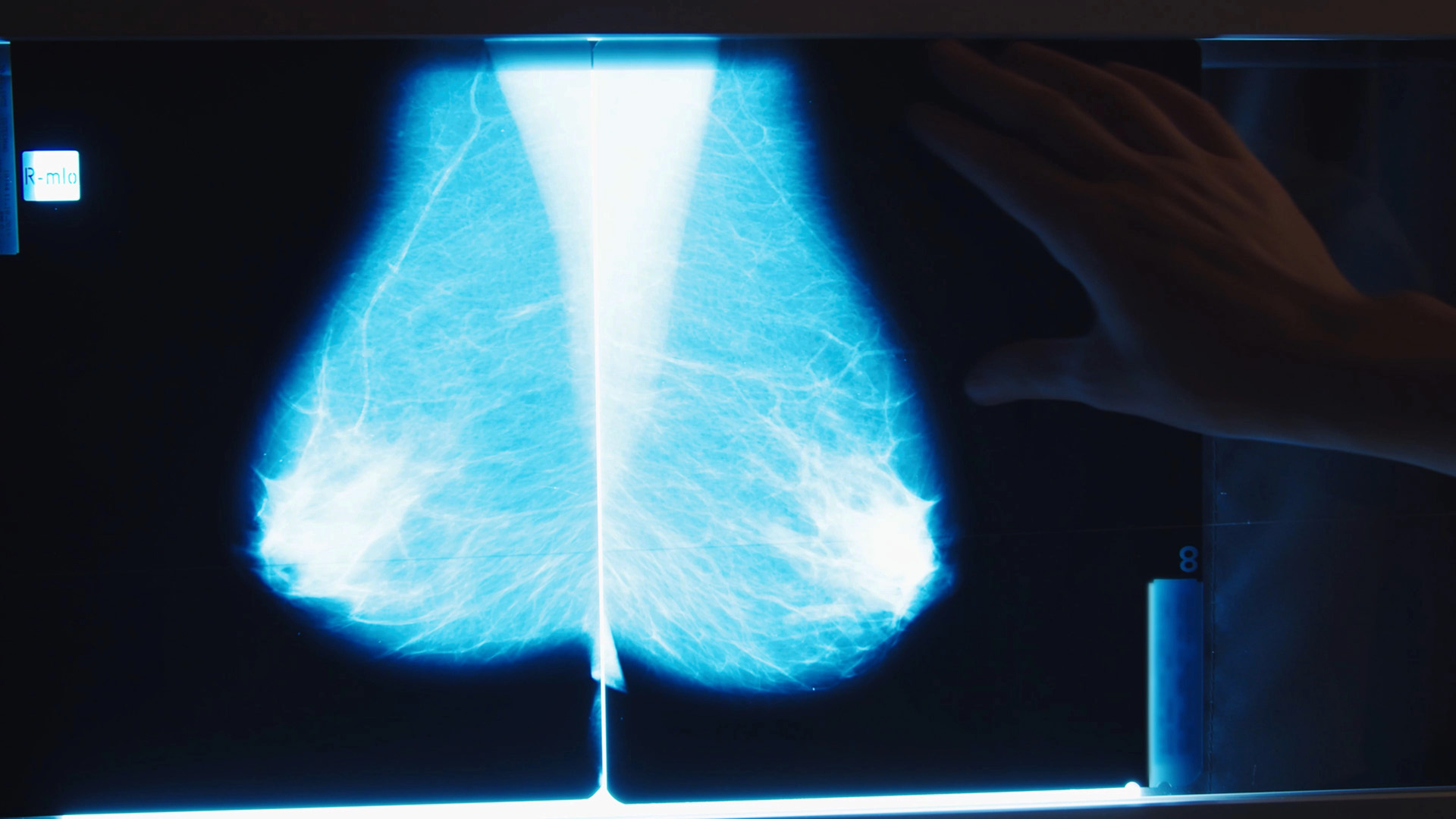 Röntgenbild på bröst.
