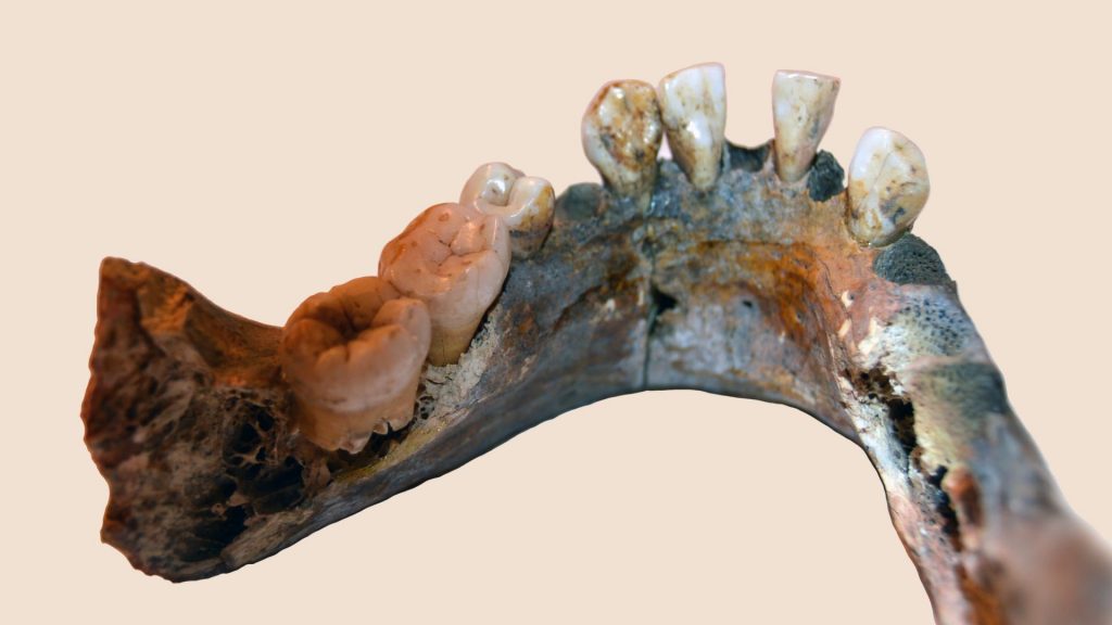 En käke från en kvarleva från människa, ben och tänder syns.