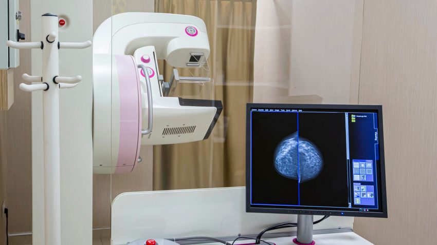 Röntgenutrustning vid mammografi och en datorbild över bröst.