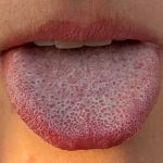 En mänsklig tunga med ett stort antal fungiforma papiller – de röda prickar som syns på tungan