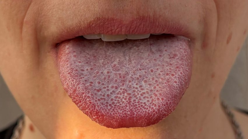 En mänsklig tunga med ett stort antal fungiforma papiller – de röda prickar som syns på tungan