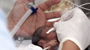 Ett mycket litet spädbarn ligger i kuvös och har slang i näsan. En stor hand med handske rör barnet.