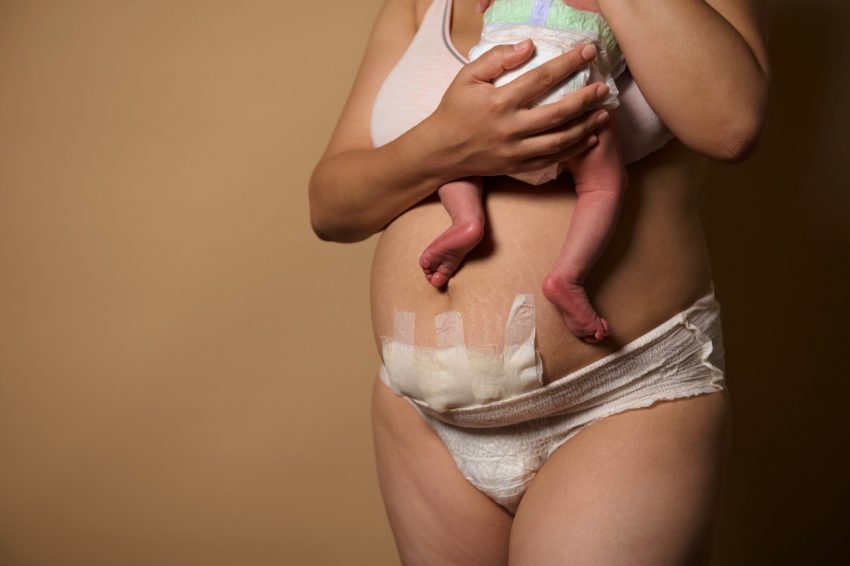 En kvinna med en nyfödd bebis i famnen. På nedre delen hennes mage syns bandage.